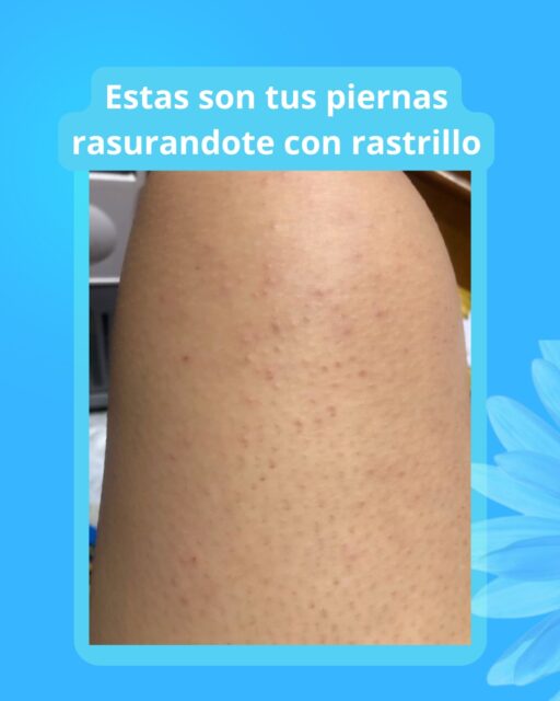 ✨ Spray Depilador ✨

Olvídate del rasurado incómodo y disfruta una piel suave en minutos 💖

✔ Remueve el vello de forma rápida y fácil
✔ Ayuda a dejar la piel suave y lisa
✔ Fórmula práctica y cómoda de aplicar
✔ Ideal para piernas, brazos, axilas y más