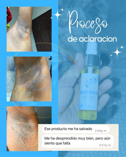 ✨ El proceso habla por sí solo 💙

Así va el proceso de aclaración de una de nuestras clientas utilizando SuBlue Peeling Oil. 🫧✨

La piel continúa desprendiéndose poco a poco como parte del proceso.

⚠️ No recomendado para piel sensible. Sigue siempre las instrucciones de uso.

#SuBlue #PeelingOil #ProcesoDeAclaracion #CuidadoDeLaPiel #SkinCareRD PielUniforme SuBlueOficial ResultadosReales