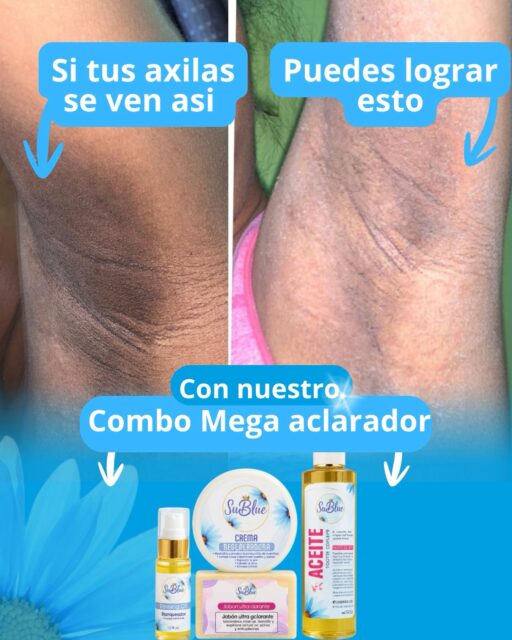 ¿Tus axilas se ven más oscuras de lo normal? 👀💙

La hiperpigmentación puede aparecer por el roce, la depilación, productos fuertes y otros factores.

Nuestro Combo Aclarador SuBlue está pensado para ayudar a mejorar la apariencia de manchas, mantener la piel hidratada y dejarla más suave y uniforme ✨

La constancia hace la diferencia 💙

Cuida tu piel, no la escondas.

🛍️ Disponible en sublueoficial.com
📦 Envíos nacionales e internacionales
#SuBlue #ComboAclarante #Axilas #Hiperpigmentacion #CuidadoDeLaPiel PielUniforme SkincareRD ManchasEnLaPiel